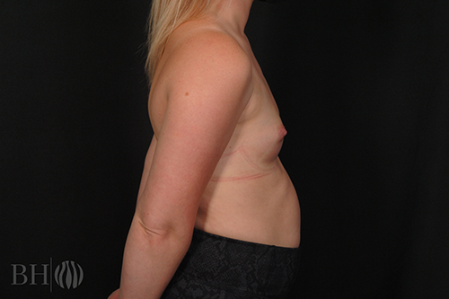 Breast Augmentation With Lift Before & After
